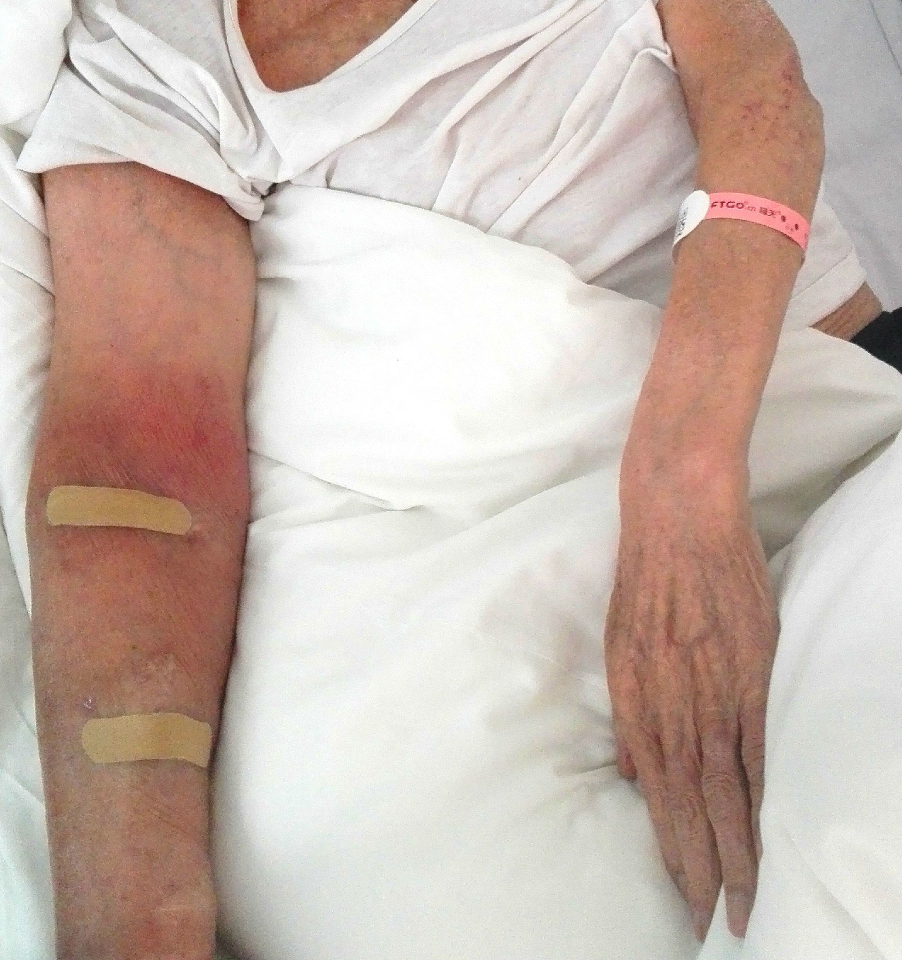 透析通路治疗之--肿胀手综合征 - 好大夫在线