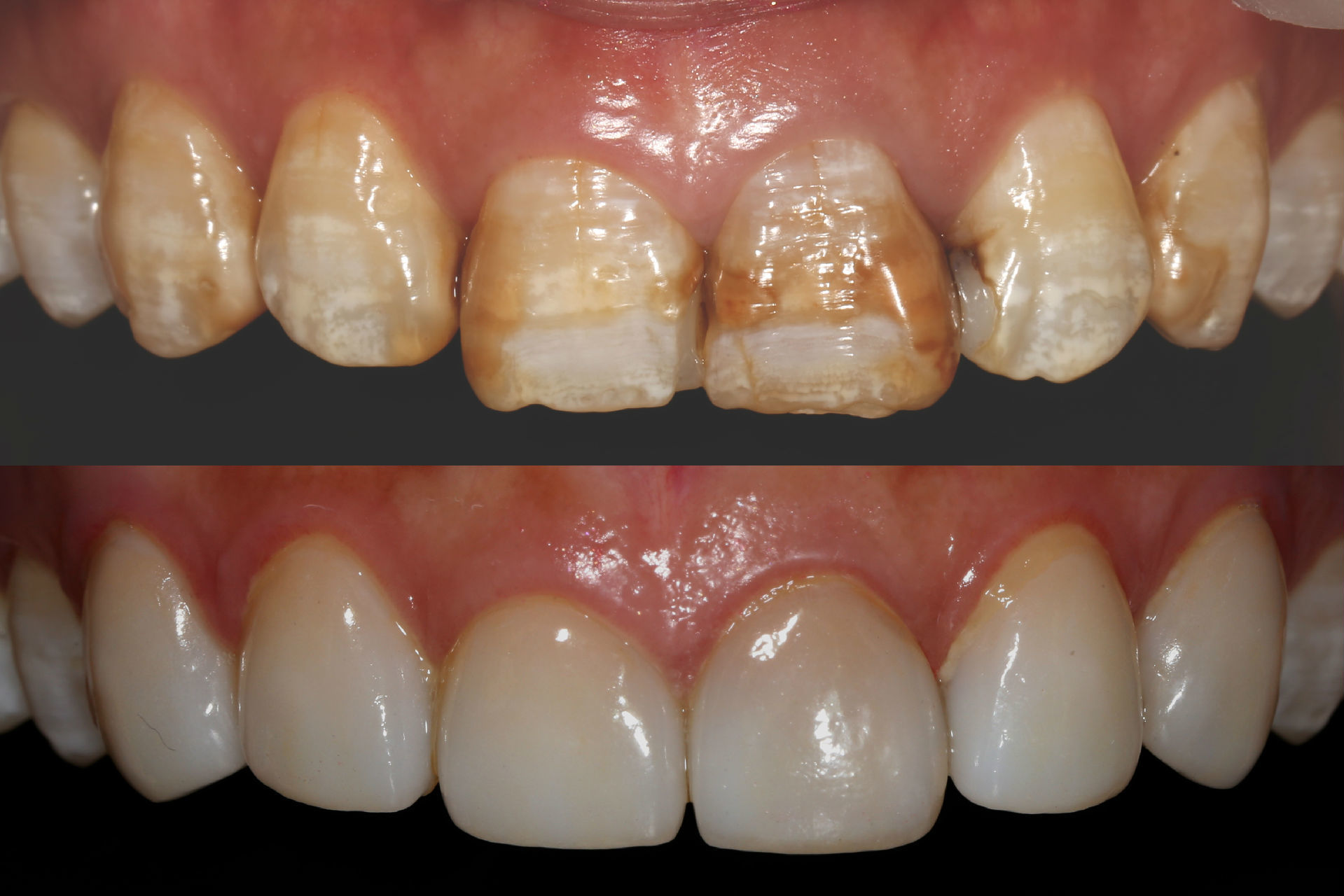 瓷贴面修复氟斑牙 一例