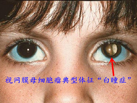 白化病的眼睛图片