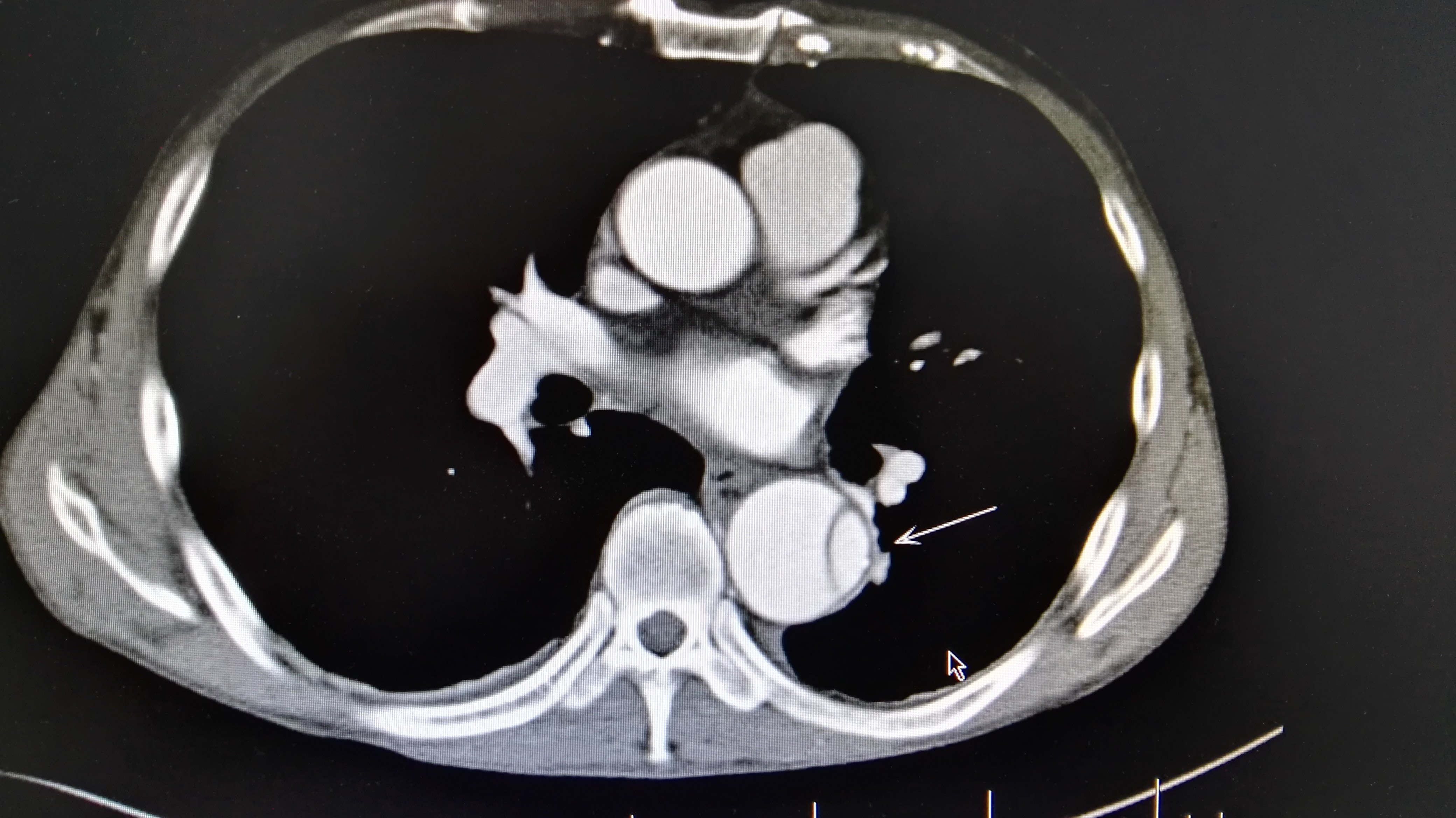 主动脉b型夹层腔内治疗术 - 好大夫在线