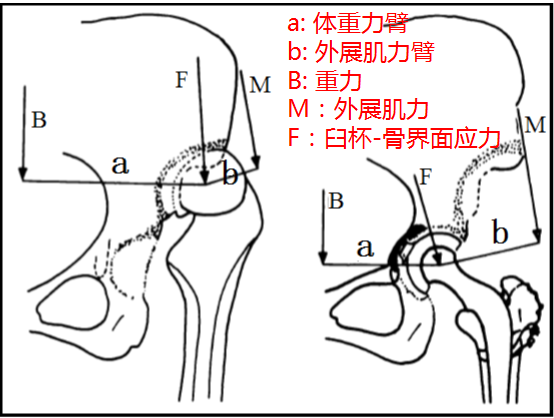 全髋关节置换术治疗髋关节发育不良—我是如何处理髋臼 - 好大夫在线