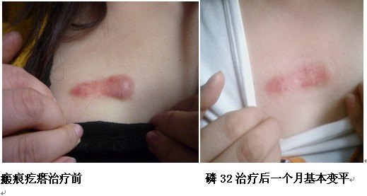 疤痕疙瘩同位素敷贴治疗典型案例(山东青岛) 