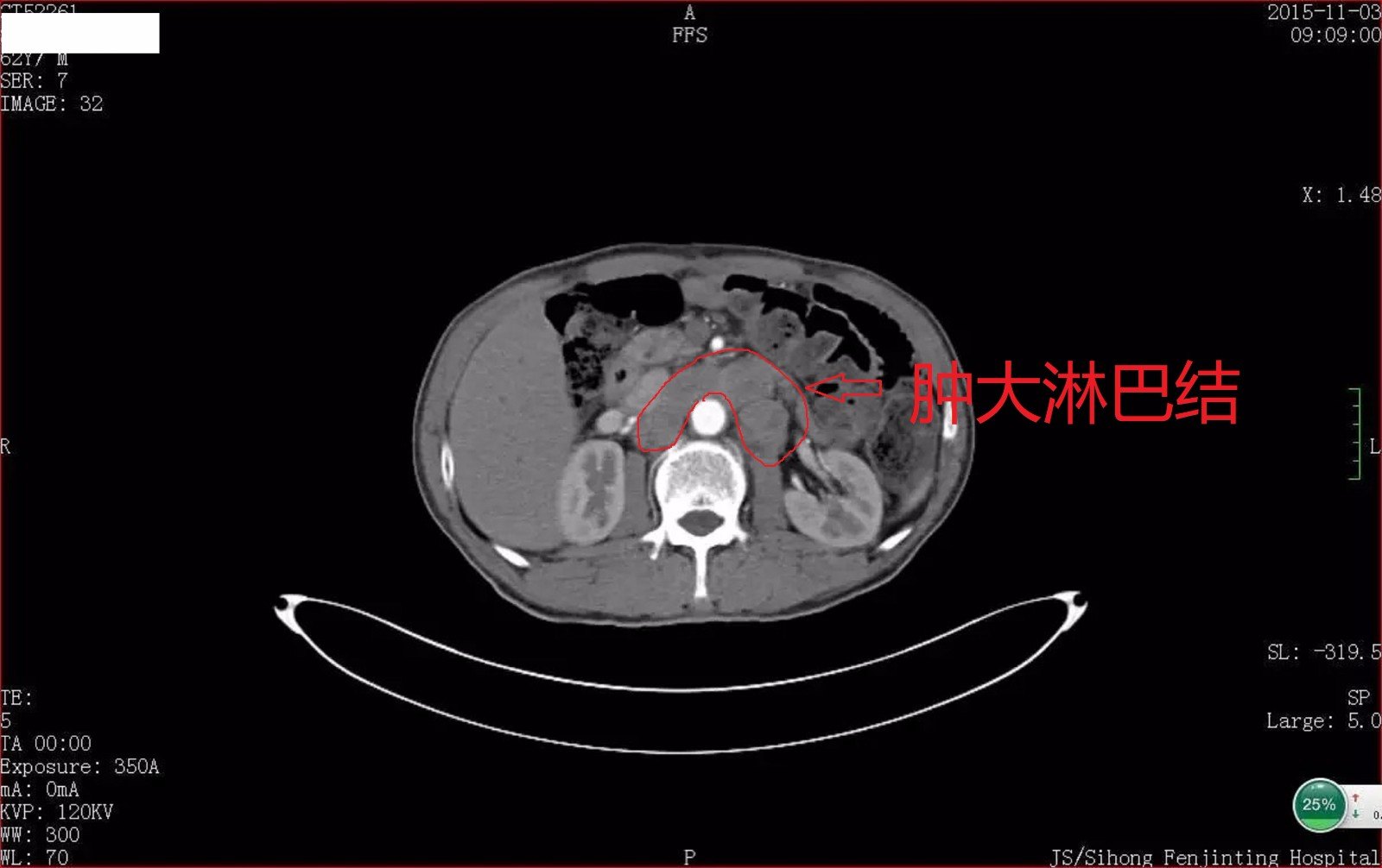 胃癌腹膜后淋巴结转移海扶手术病例