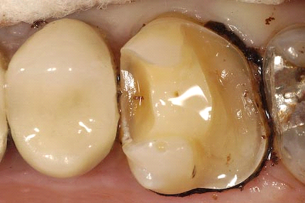 我是如何处理食物嵌塞 - 好大夫在线