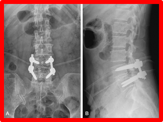内椎间盘切除合并腰椎不稳腰椎管狭窄者,需要同时行脊柱融合术近年来