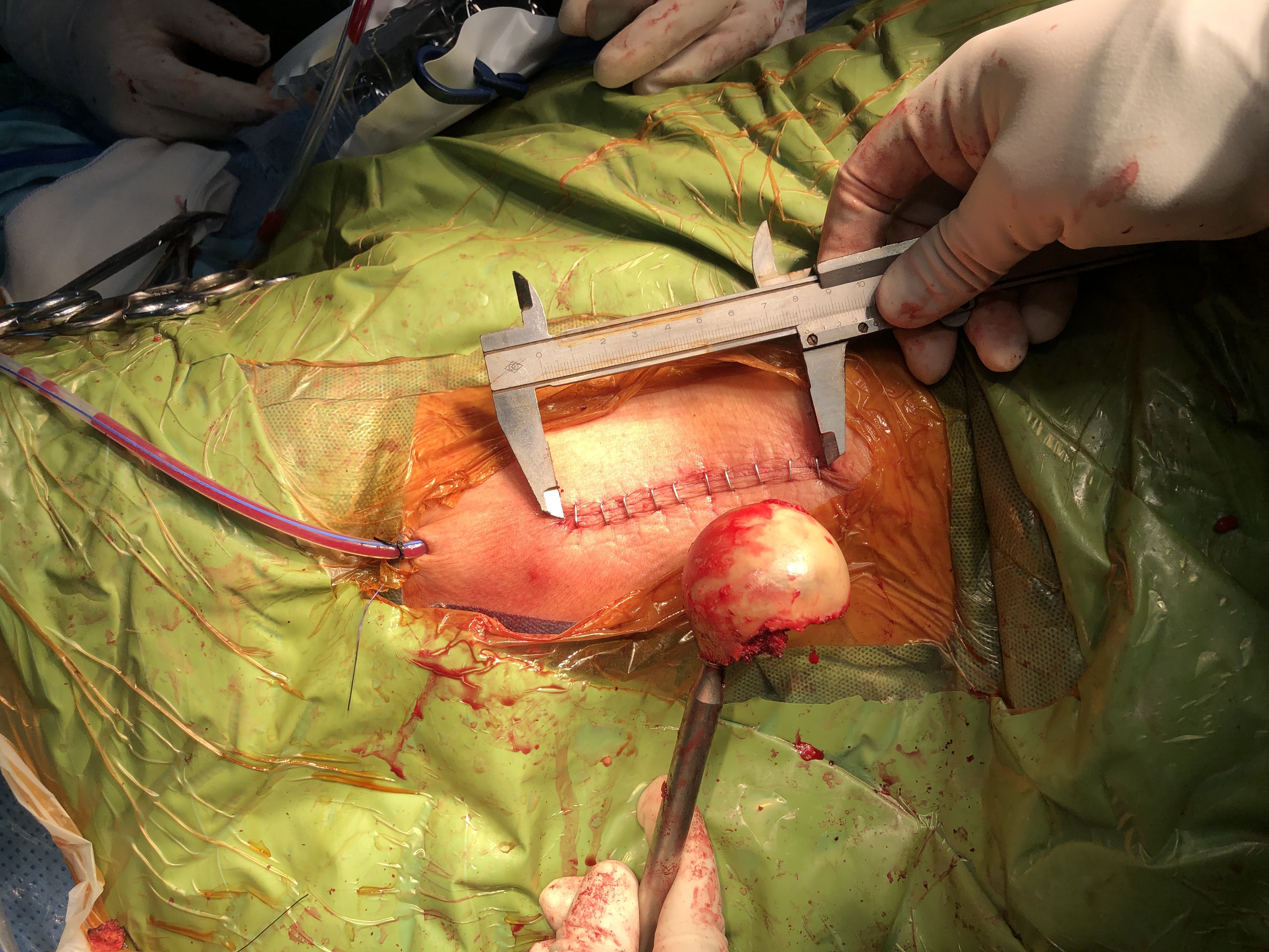 老年人,股骨颈骨折,行髋关节前路手术,术后第二日下地 - 好大夫在线