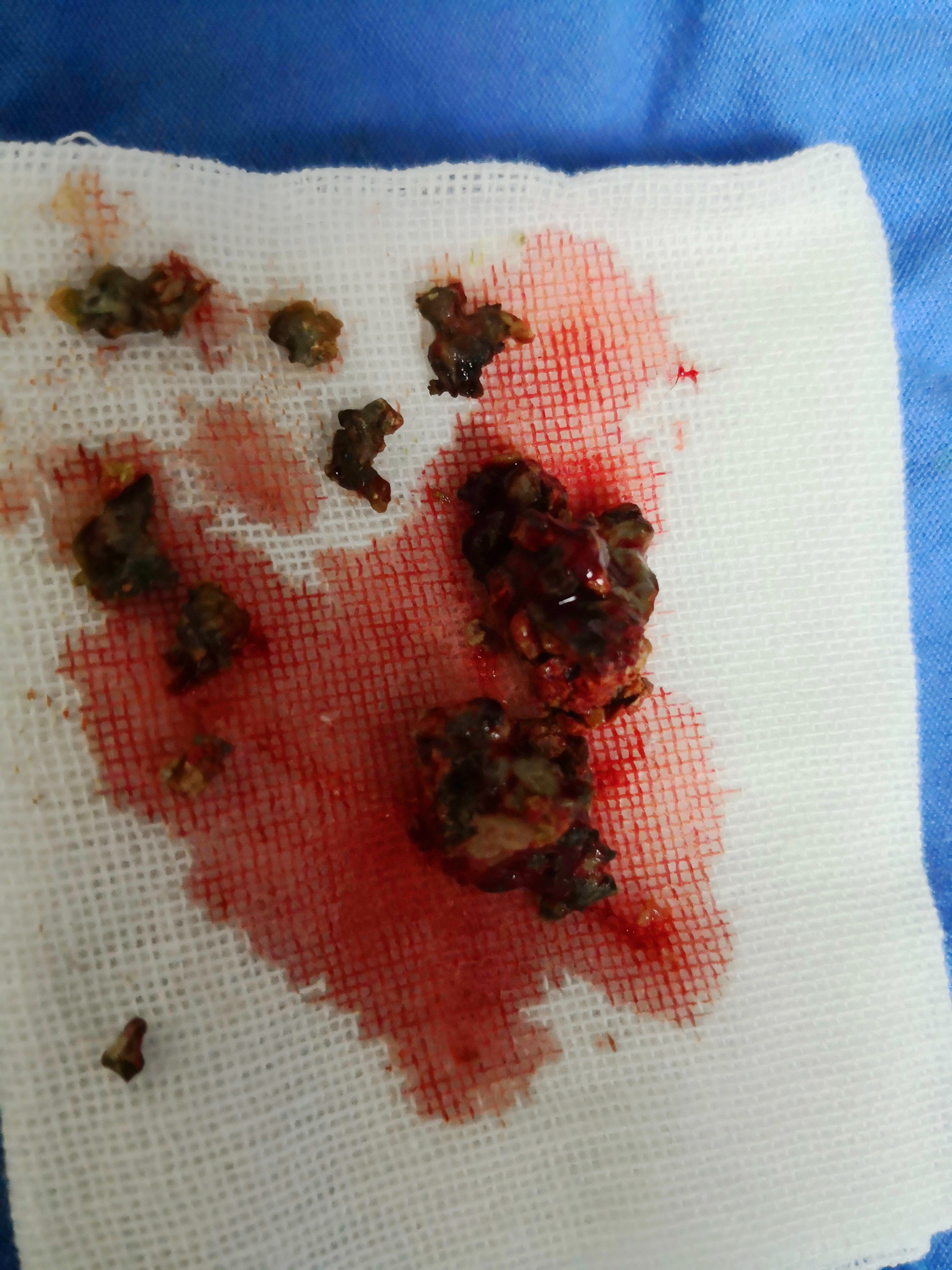 导致口臭一些不被留意的病灶