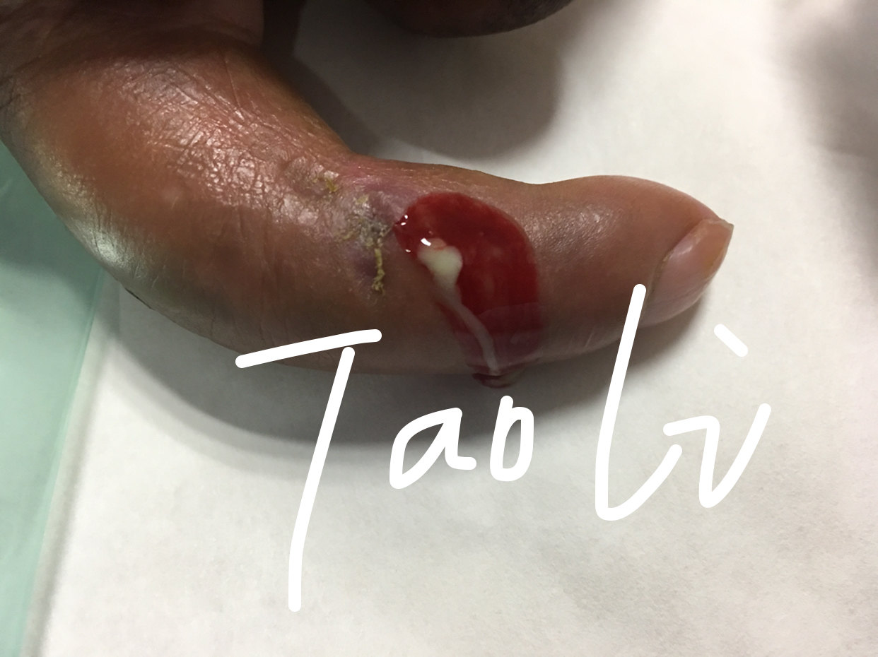 手指异物刺伤引起的感染 - 好大夫在线