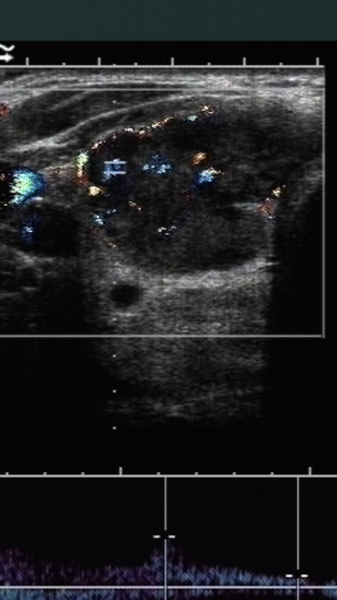 超声诊断甲状腺滤泡癌1例