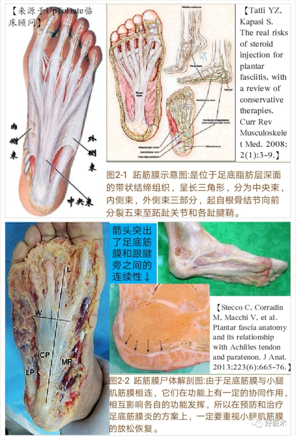 一文详解 足底跖筋膜炎的诊治策略 一文详解 足底跖筋膜炎的诊治策略