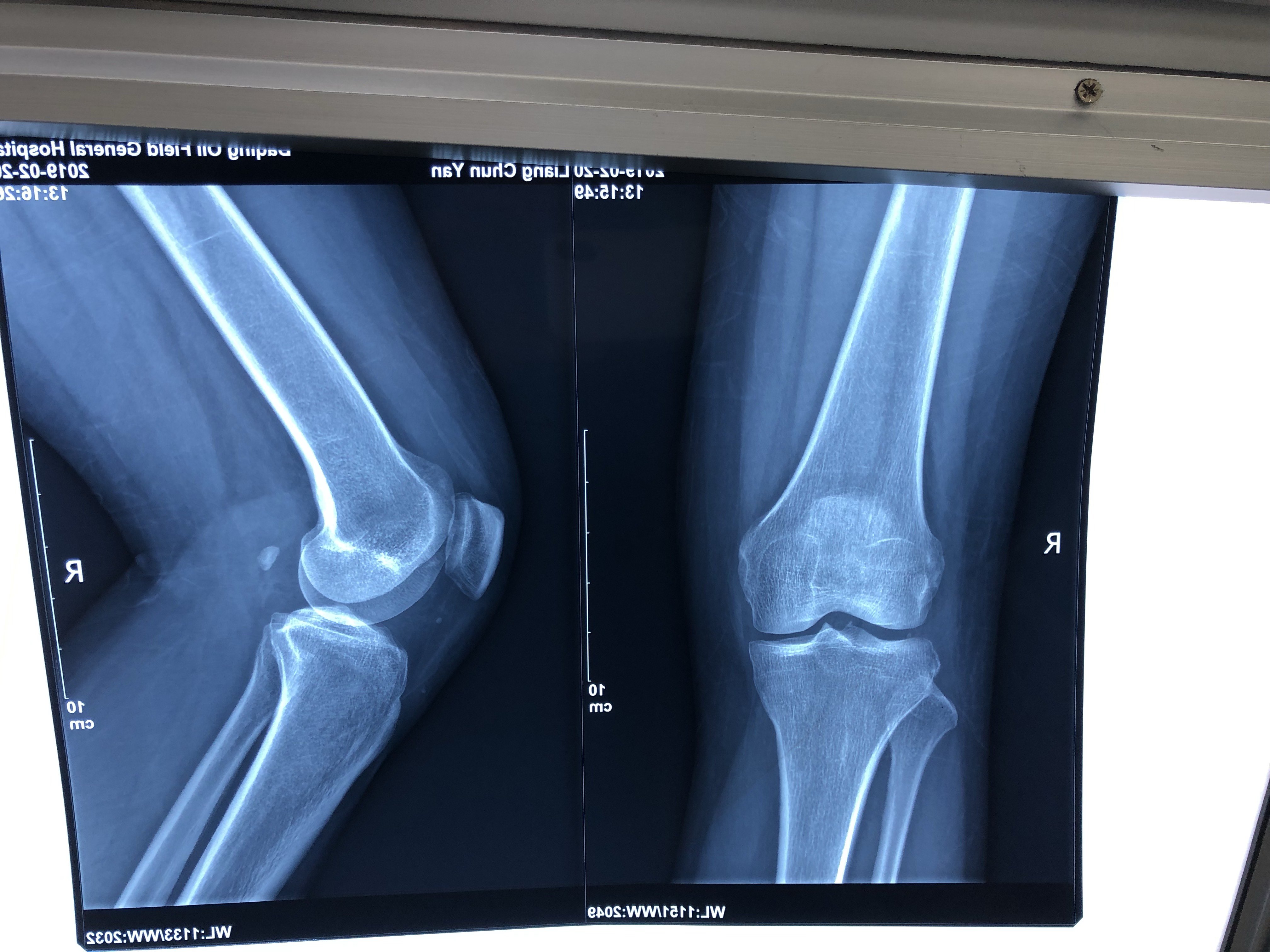 膝关节前叉韧带断裂,关节镜下韧带重建 
