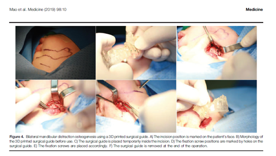 介绍了本院皮罗氏序列征的治疗效果;描述了本院设计,制作手术导板的过