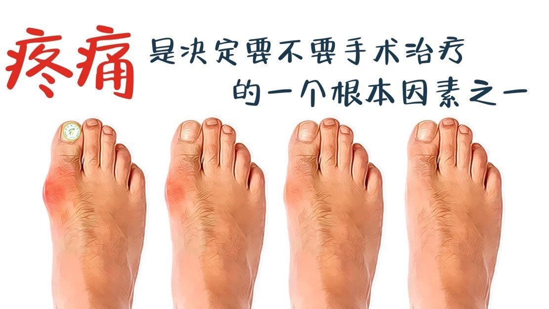 对于拇外翻的治疗方案除了考虑脚趾变形的程度,自己的疼痛度以及疼痛