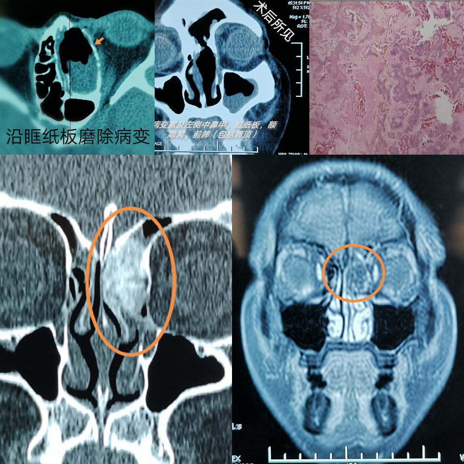 鼻窦骨瘤图片