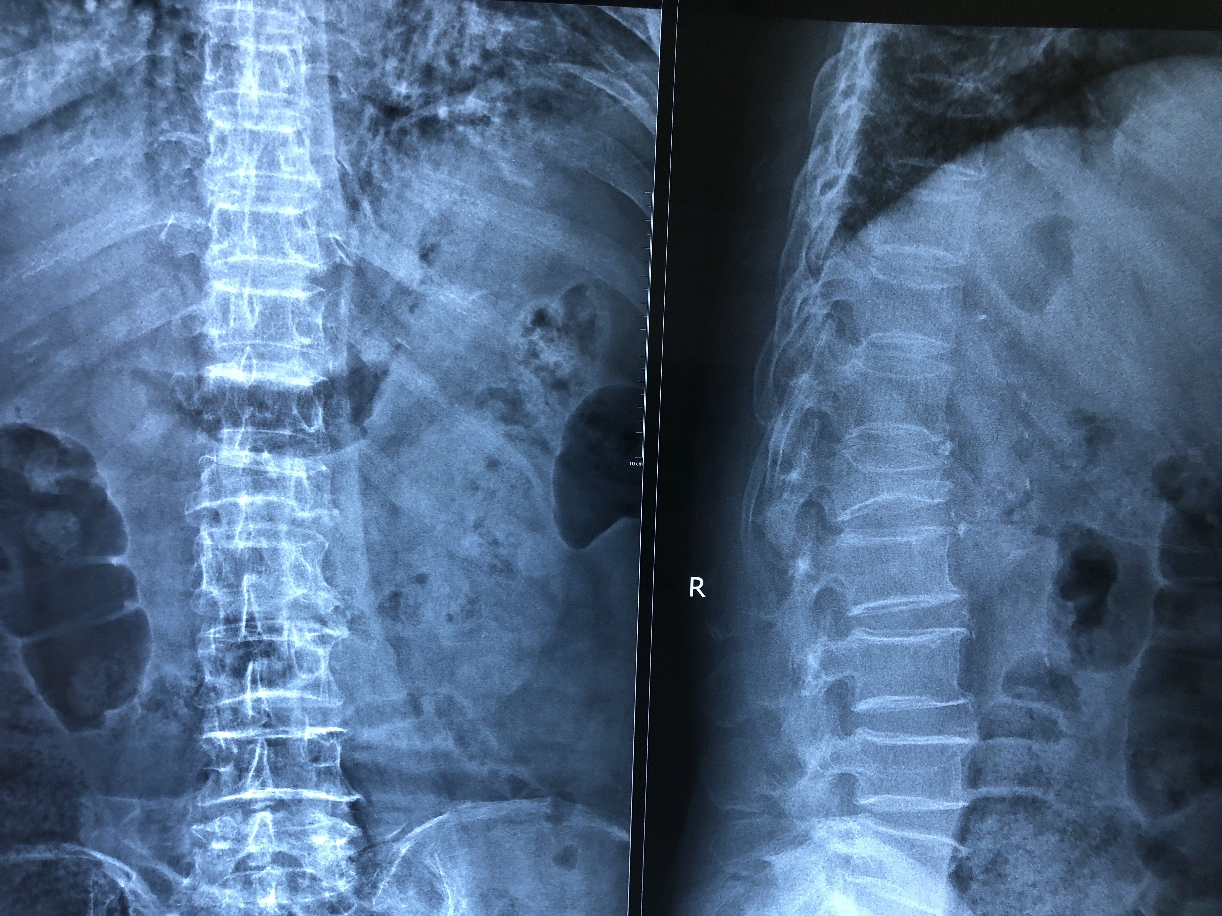 腰椎第一节压缩性骨折图片