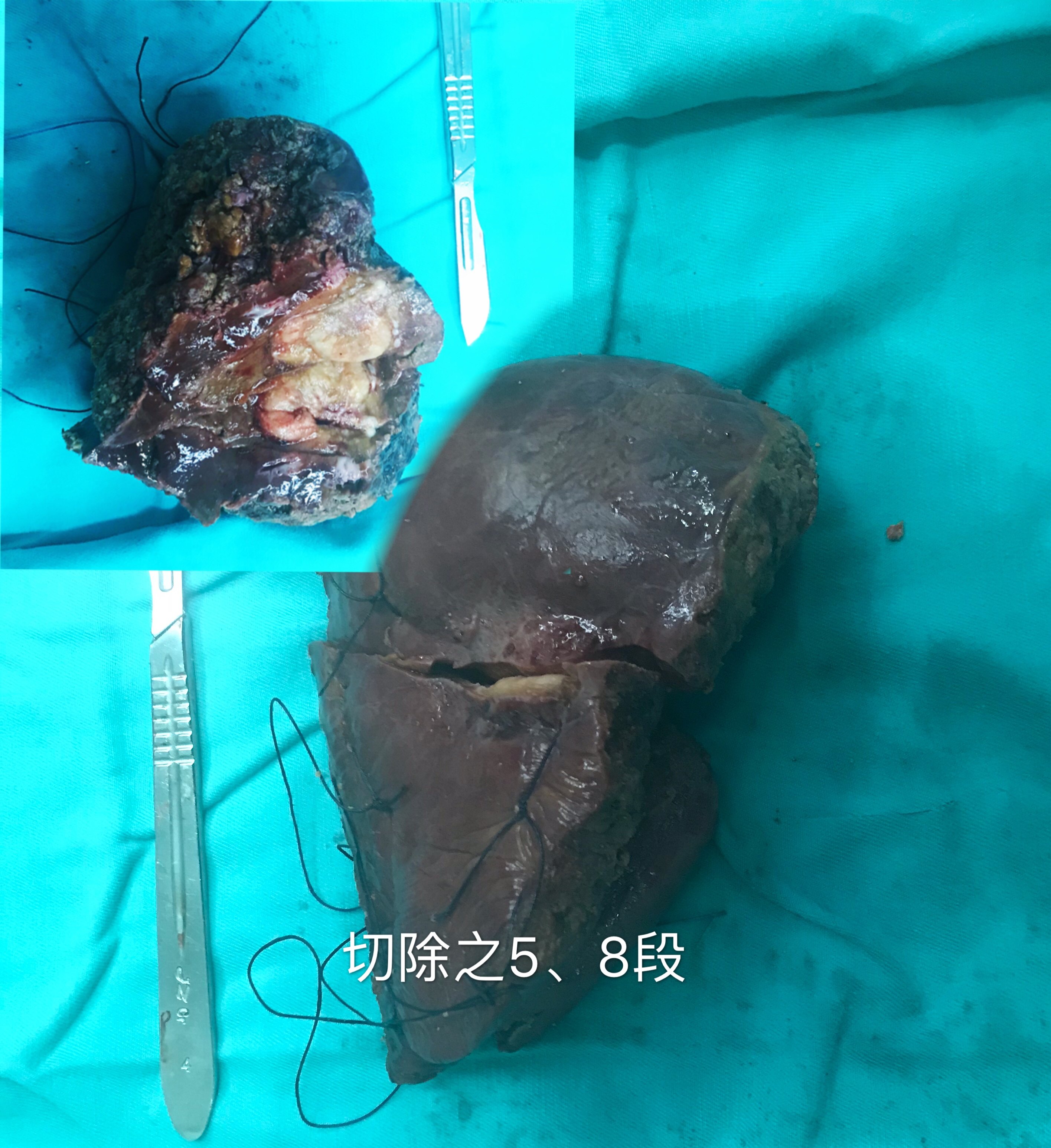 肝脏罕见的良性肿物:炎性假瘤 - 好大夫在线