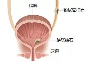 膀胱結石示意圖.jpg