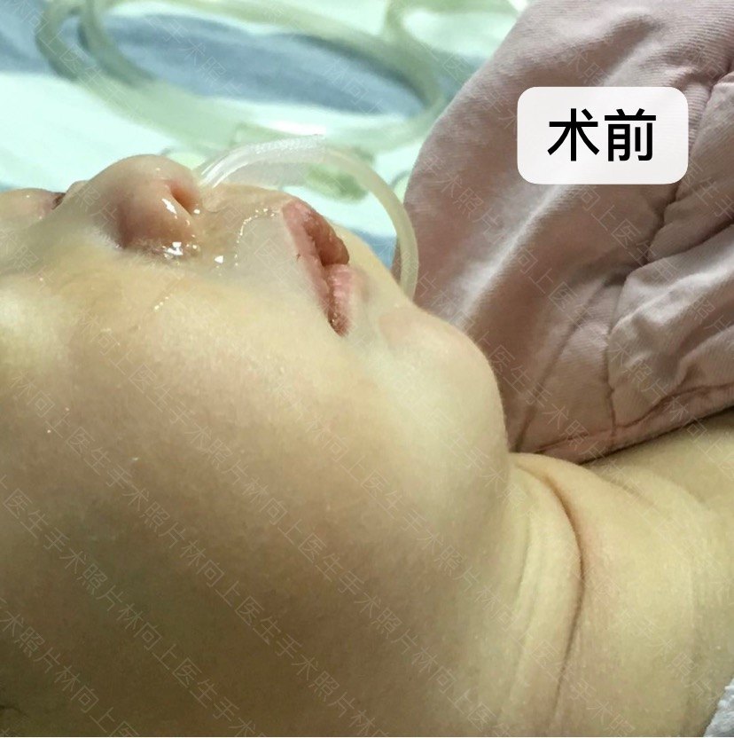 pierre-robin综合征(小下颌畸形) - 好大夫在线