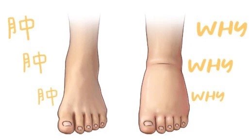 你的jio肿么了 揭秘脚肿到底是不是病 淋巴水肿 疾病介绍 你的jio肿么了 揭秘脚肿到底是不是病 淋巴水肿 疾病介绍