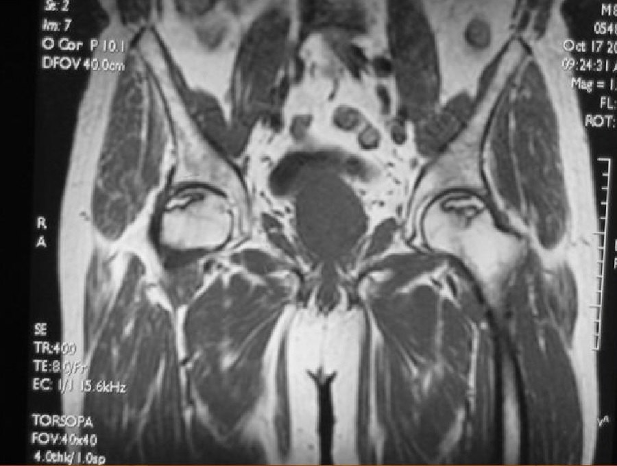 股骨头坏死2期-2.jpg