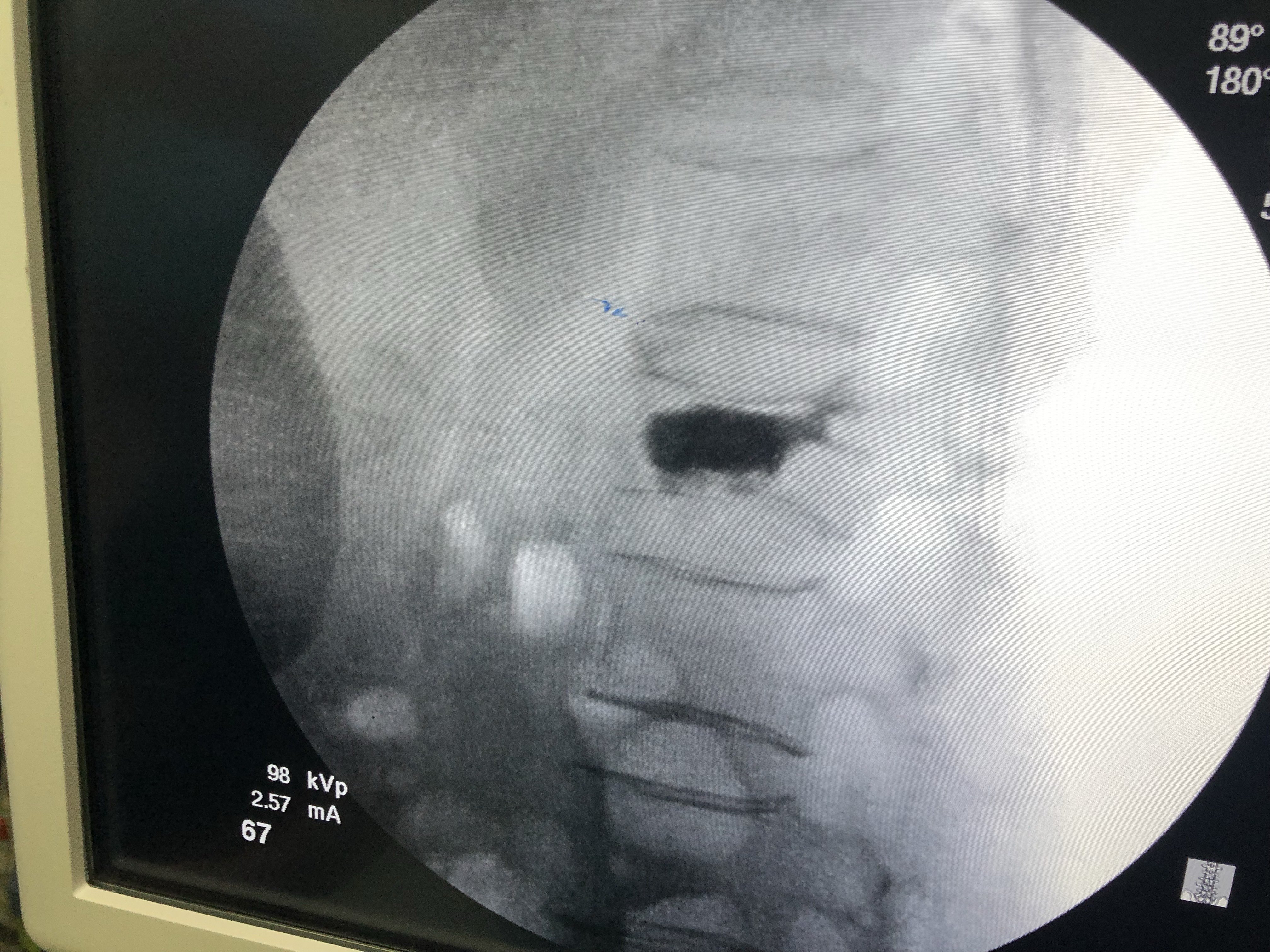 打入骨水泥植入球囊進入椎體正位定位術中定位,側位腰椎l1壓縮性骨折