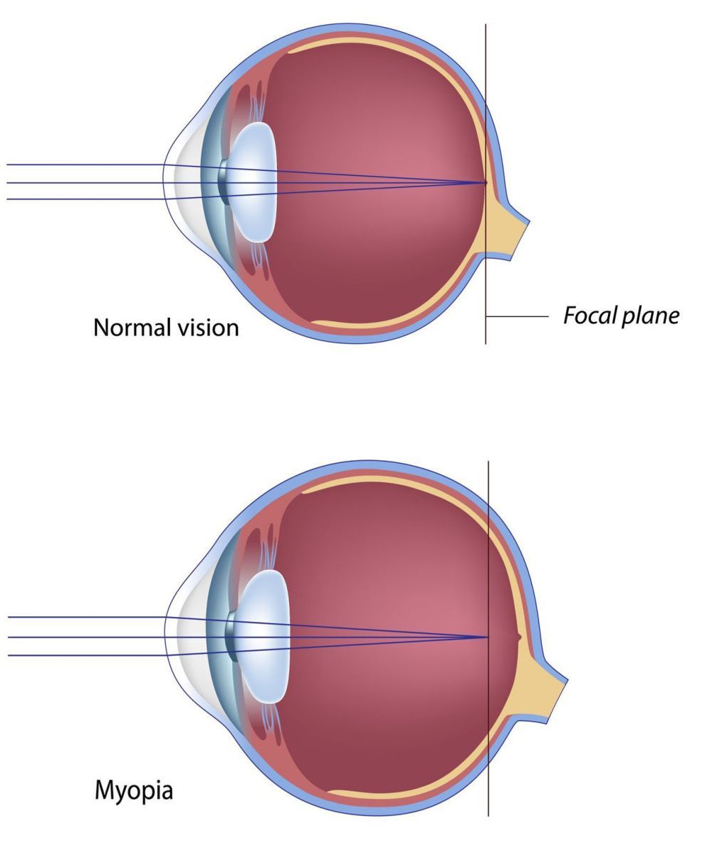 1557735033169603.jpg Myopia Singapore.jpg