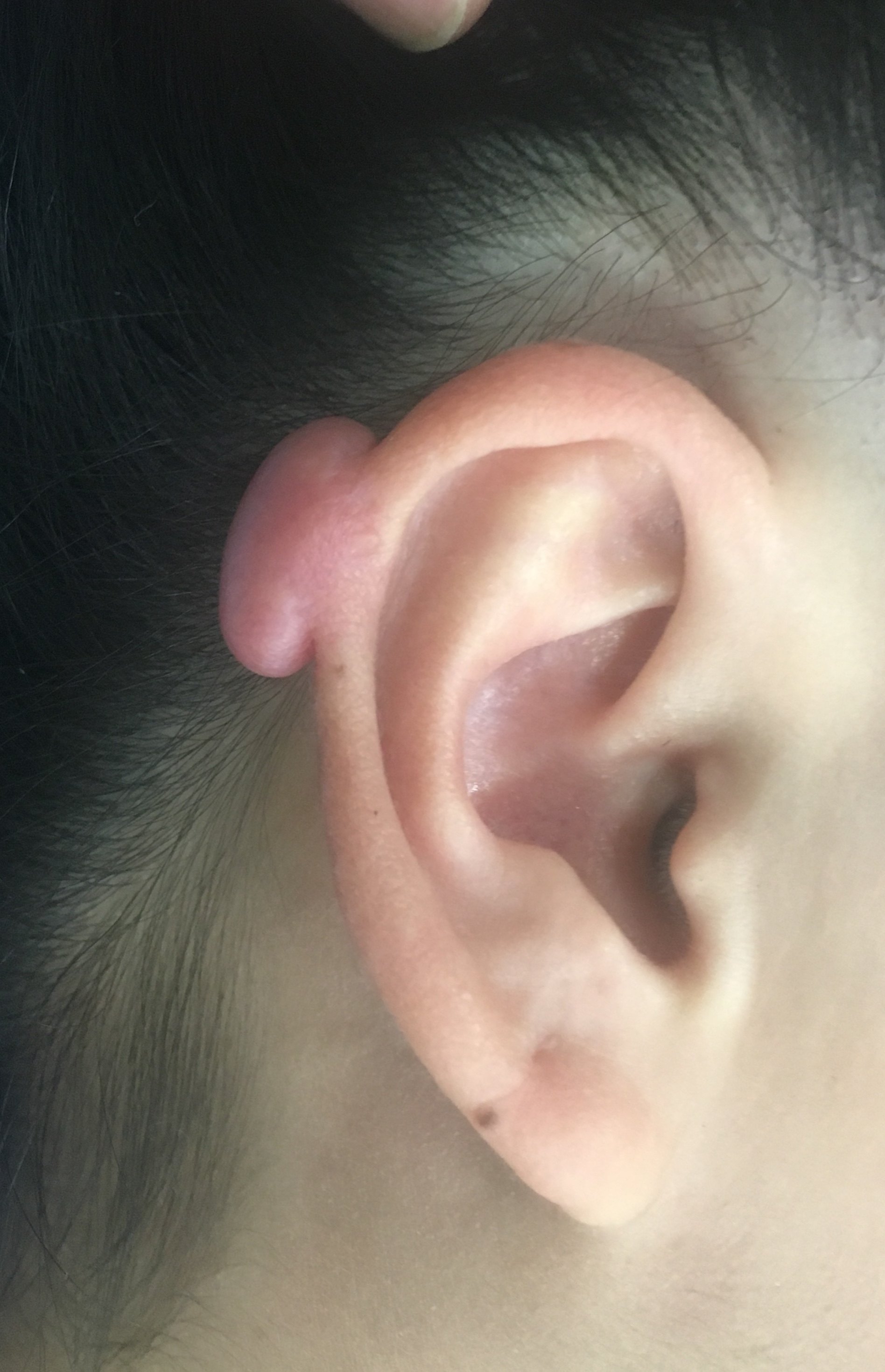 耳洞疤痕疙瘩初期图片