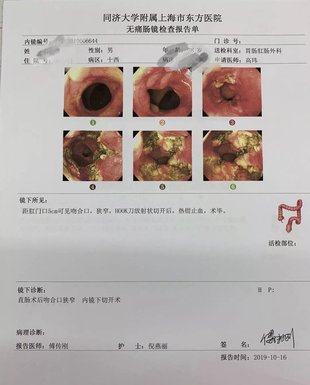 治疗吻合口狭窄竟然不用进手术室_混合痔_混合痔治疗方式 - 好大夫