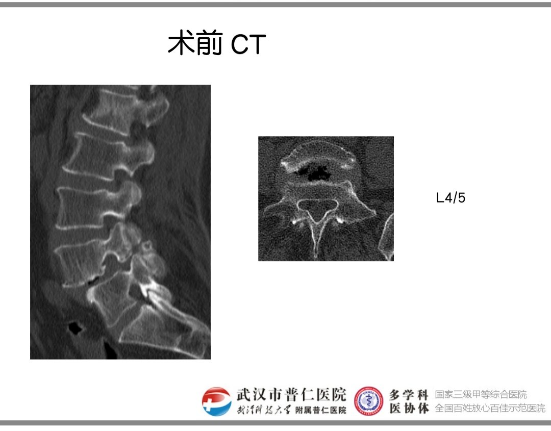 老年峡部裂型腰椎ii度滑脱的外科治疗