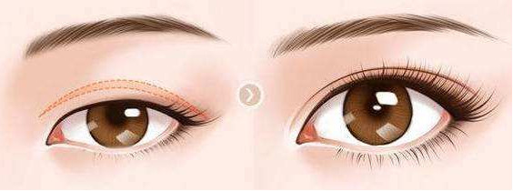 为什么割双眼皮要做上睑提肌?