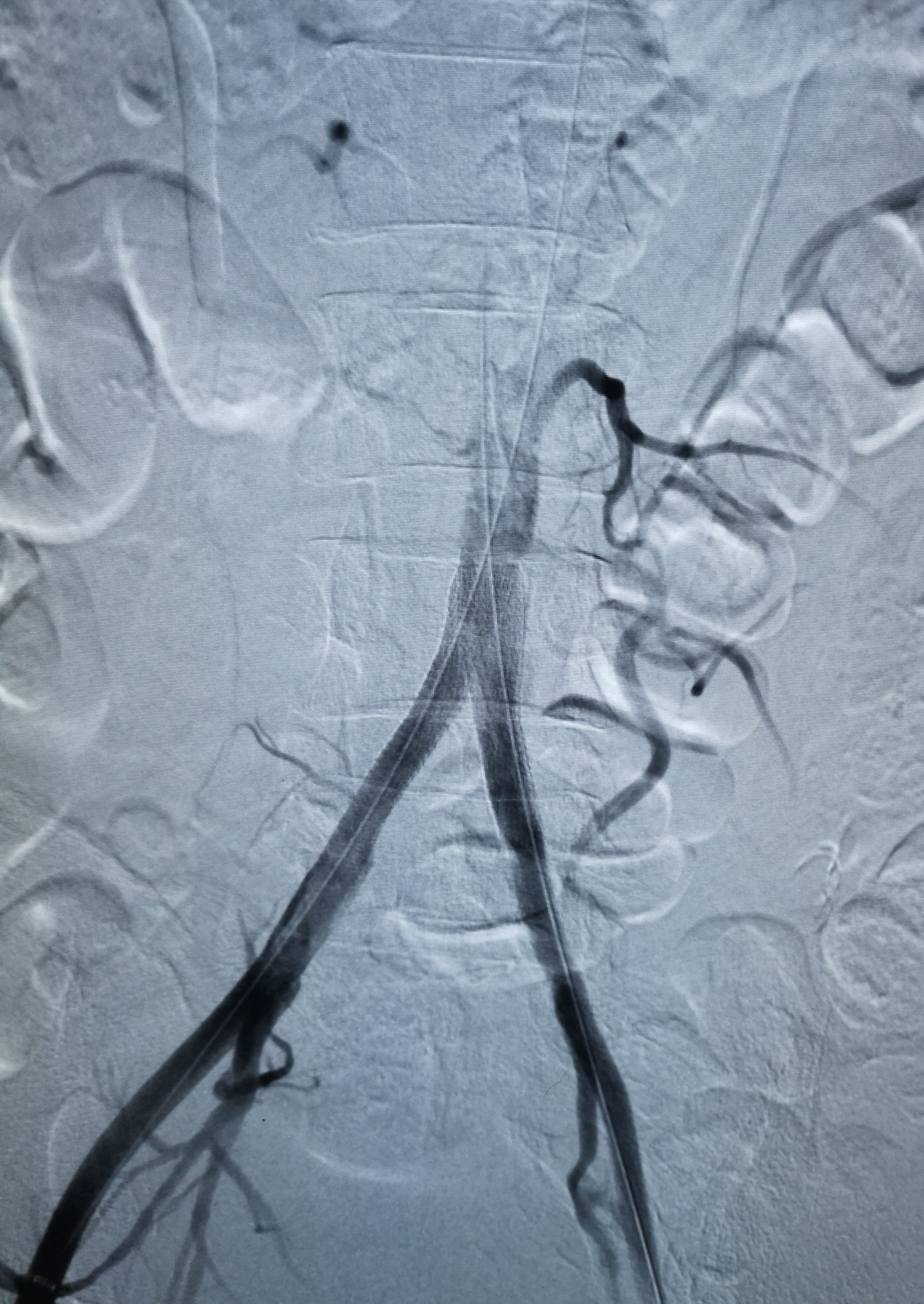 髂动脉支架植入术图片