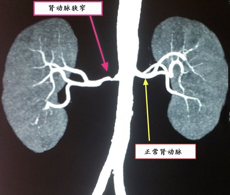 肾动脉狭窄高血压是怎么回事如何诊治怎样合理选择降血压药