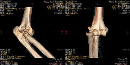 圖1:x光片和ct可見患者橈骨小頭和尺骨冠突骨折,右肘關節向後向外脫位