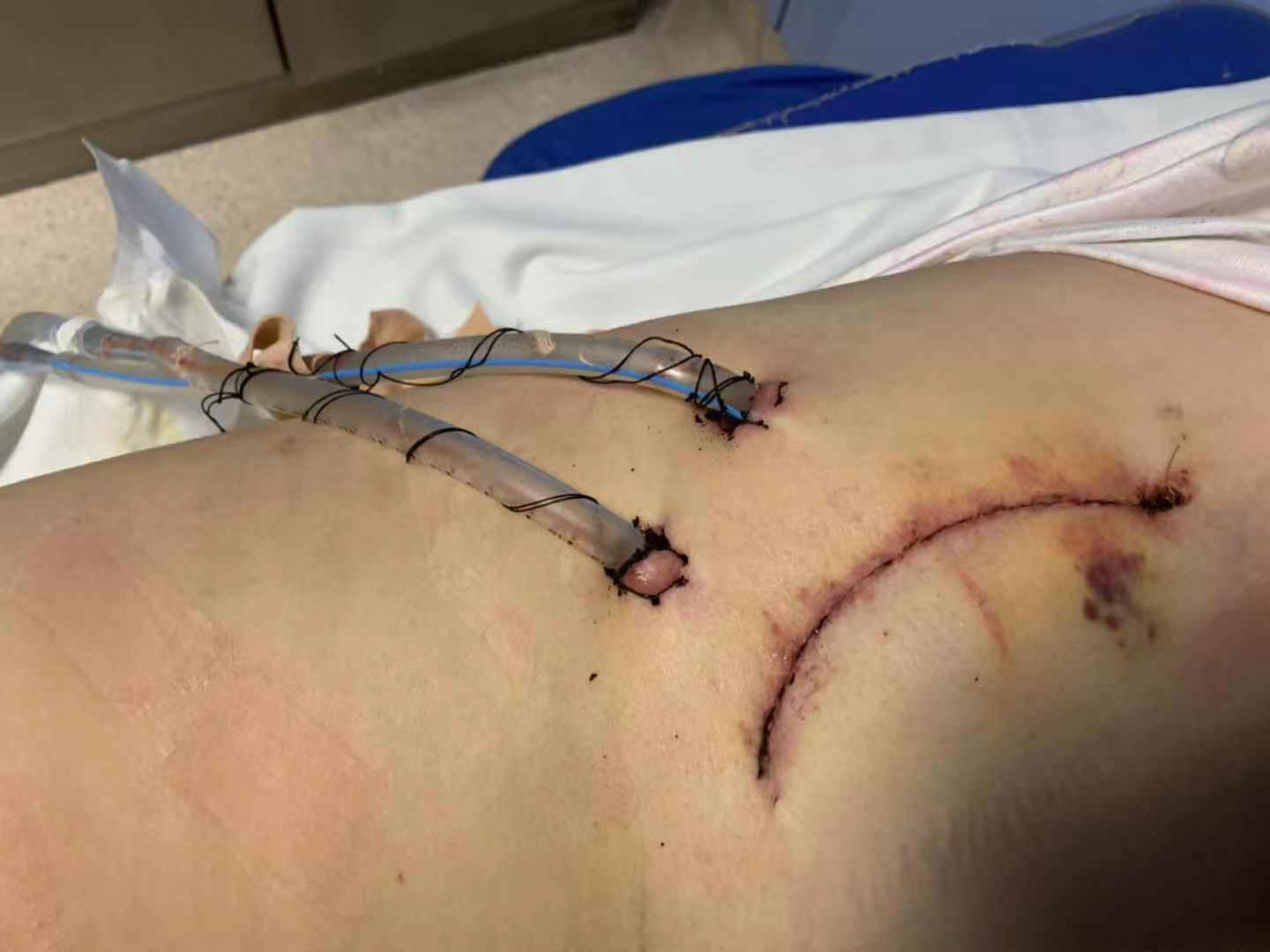 心脏支架手术疤痕图片图片