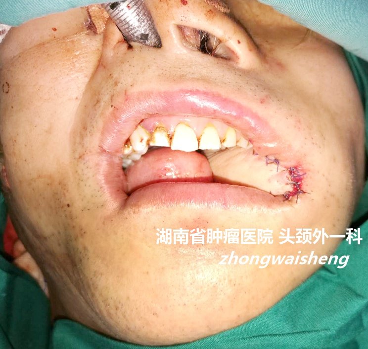 口颊癌的手术治疗(附手术图片) 