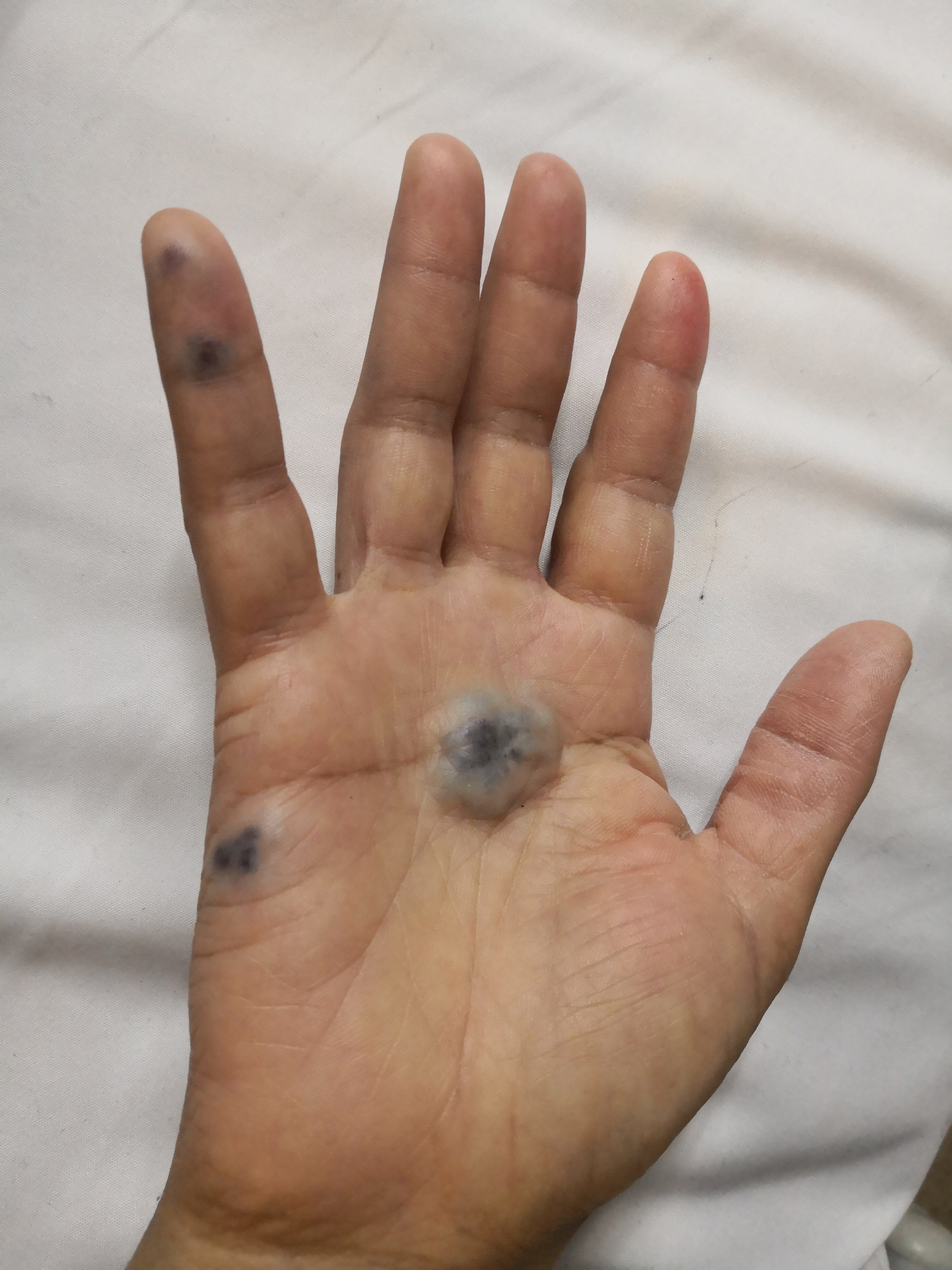 罕见疾病一例分享:蓝色橡皮庖痣综合征 - 好大夫在线