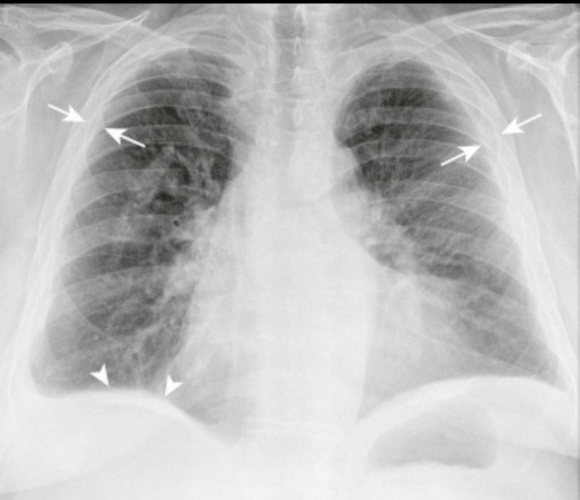 胸膜炎胸片图片