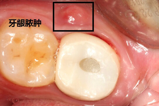 图2: 检查:全瓷牙冠修复,牙齿松动一度,叩痛明显,牙龈有脓肿