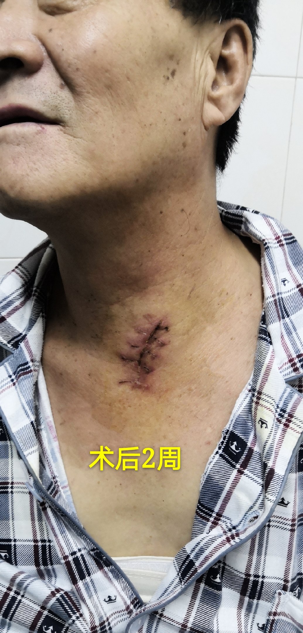 哈医大二院胸外科经典病例之微创三切口食管癌根治术 - 好大夫在线