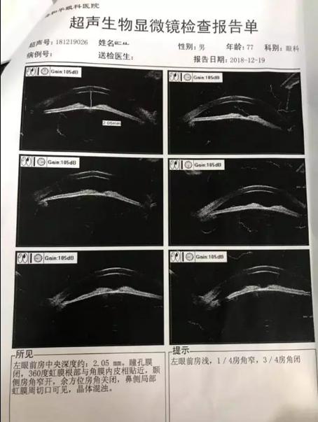 复杂青光眼合并瞳孔闭锁的治疗及效果(附视频) - 好大夫在线