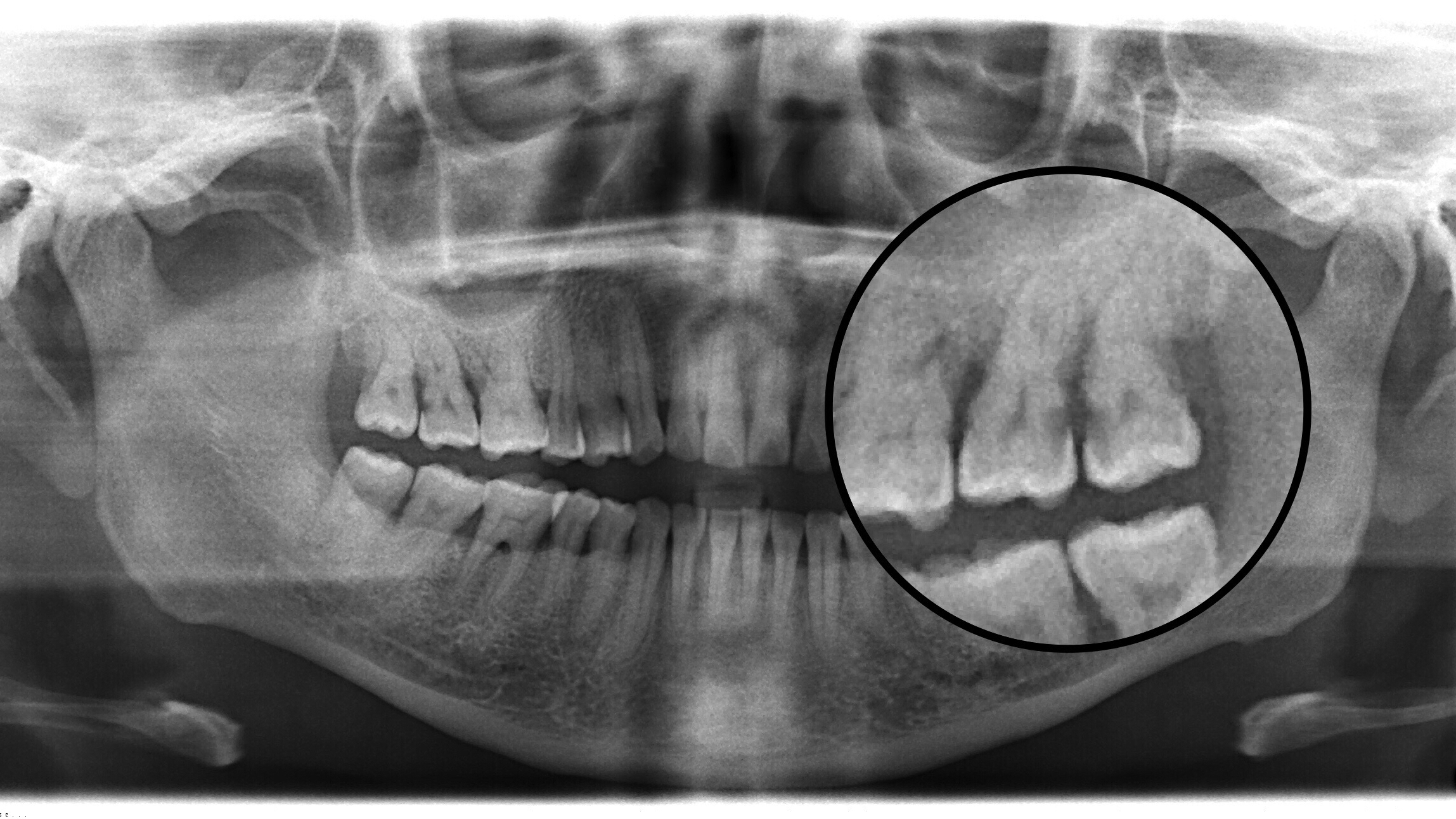 牙齿x光片龋齿图片