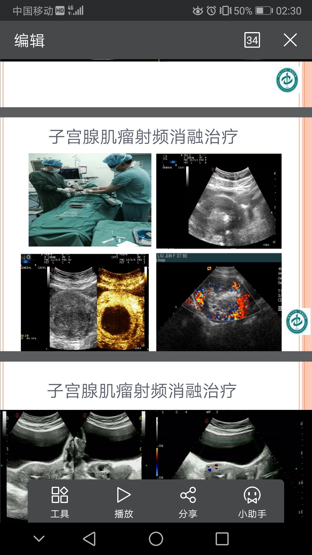 子宮內膜異位子宮腺肌症的治療