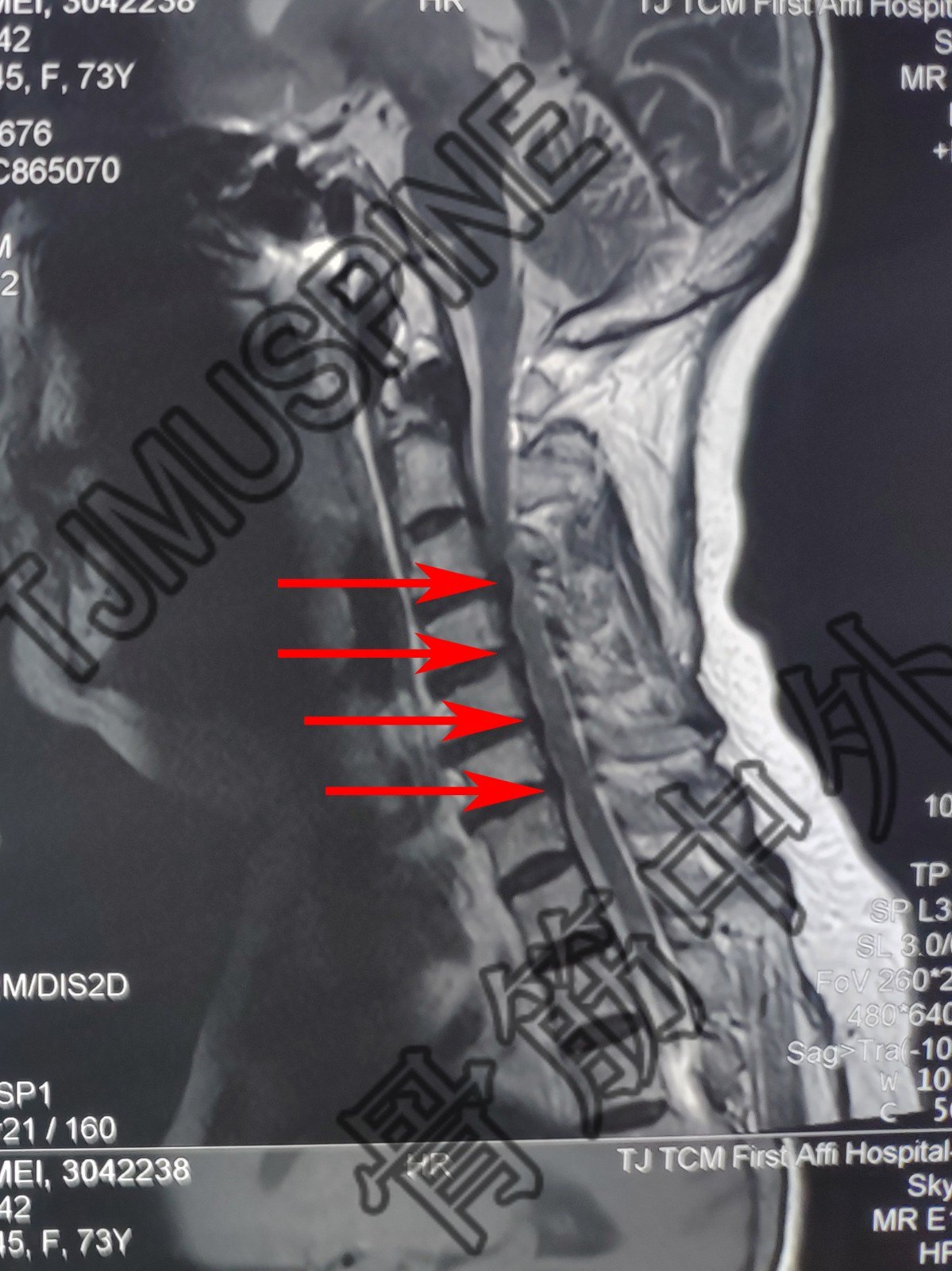 c3/4 c4/5 术前mri c3/4-c6/7椎间盘后突出,压迫硬膜囊和脊髓 c3/4