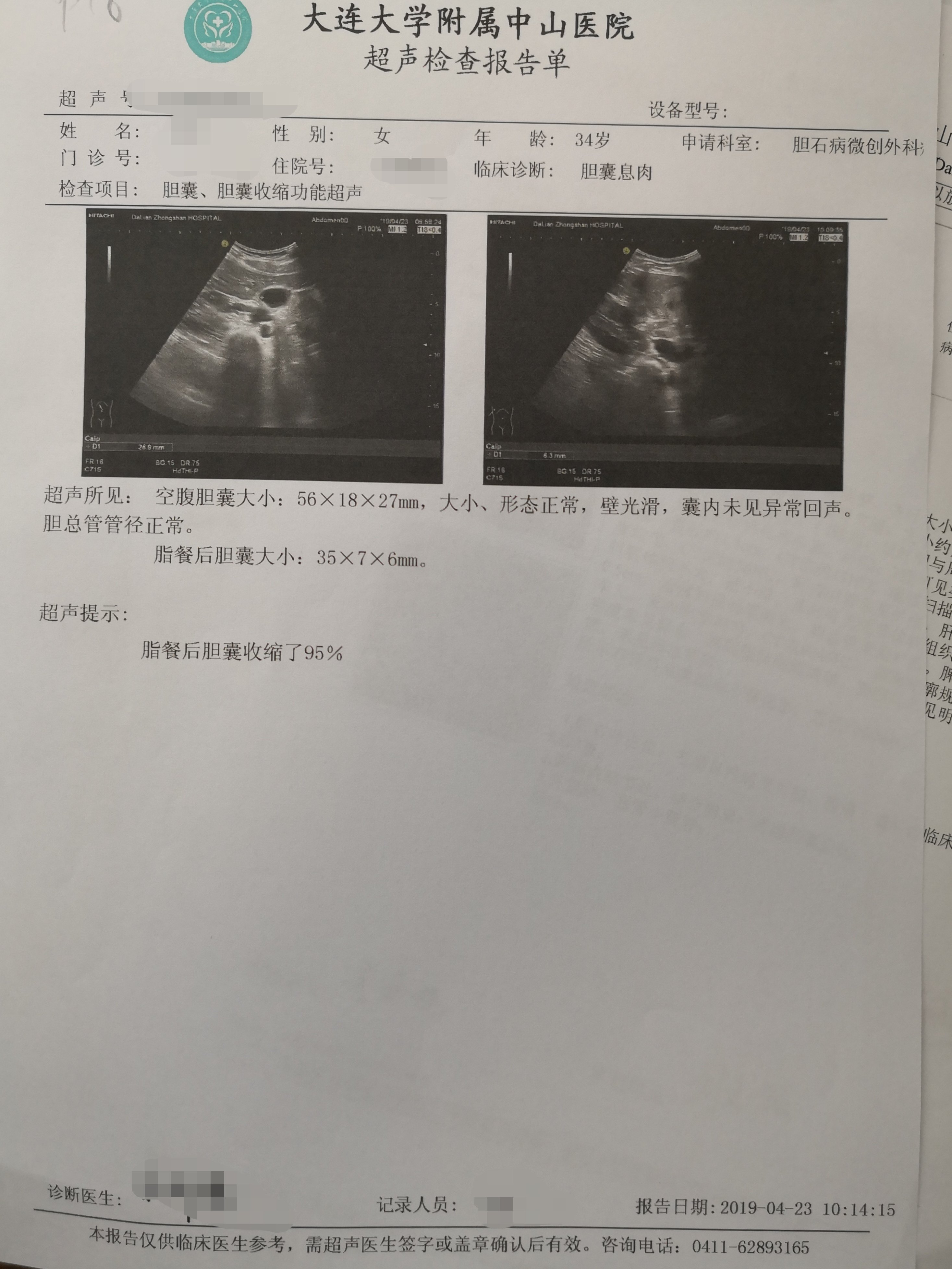 胆囊息肉医生不会告诉你的真相