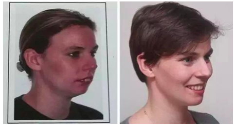 有哪些是只有戴了牙套才知道的事