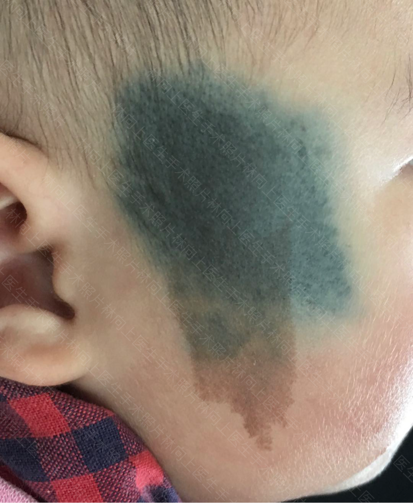 激光治疗太田痣,咖啡斑,铅笔"纹身" - 好大夫在线