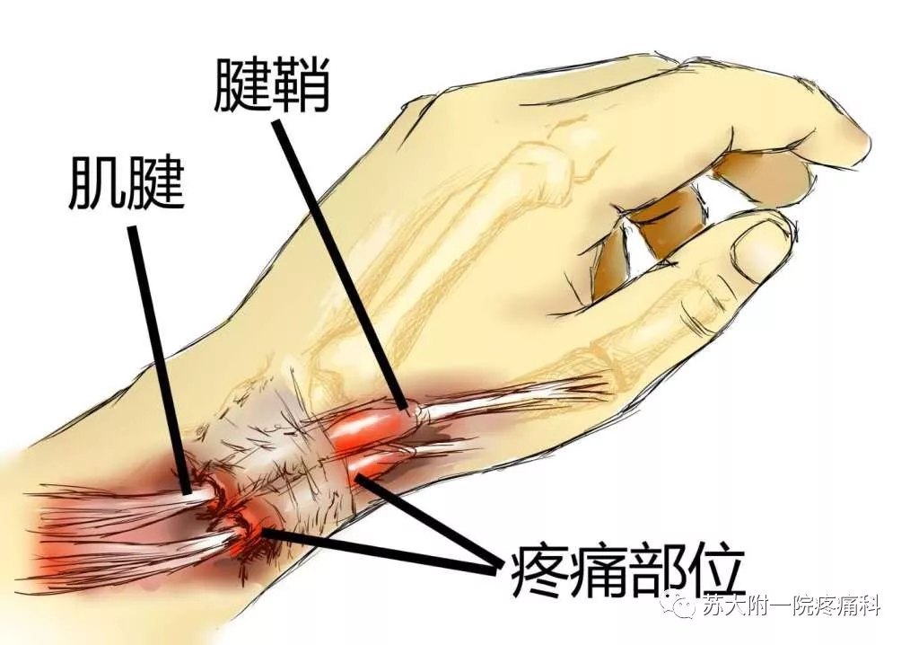 尺侧腕伸肌腱腱鞘炎图片