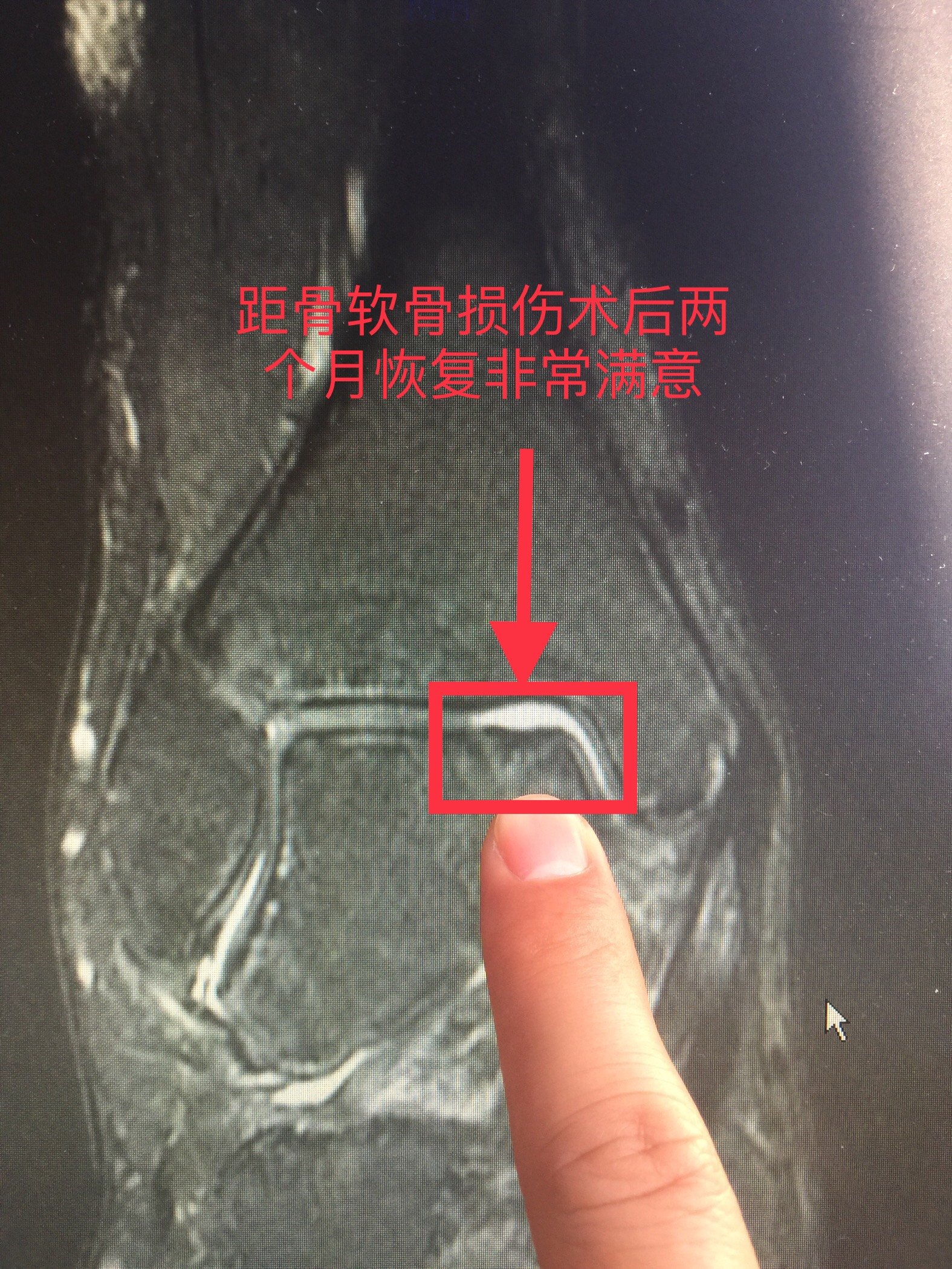 各种类型踝关节距骨软骨损伤微创治疗部分案例 