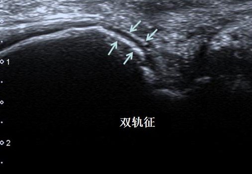 超声检查发现"双轨征","痛风石"是诊断痛风特异性较高的特征.
