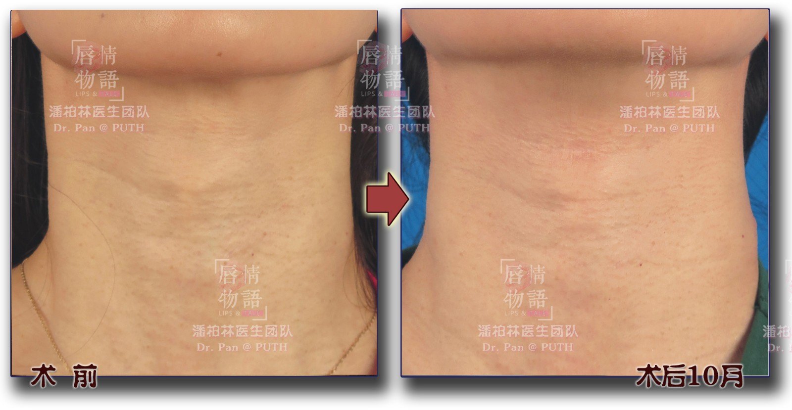 喉结缩小手术 - 好大夫在线